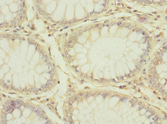 Immunohistochemistry of paraffin-embedded human colon cancer using CD97 Antibody at dilution of 1:100Rabbit anti-Human CD97 Polyclonal Antibody