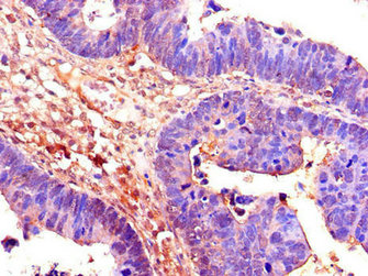 Immunohistochemistry of paraffin-embedded human ovarian cancer using CDC25B Antibody at dilution of 1:100Rabbit anti-Human CDC25B Polyclonal Antibody