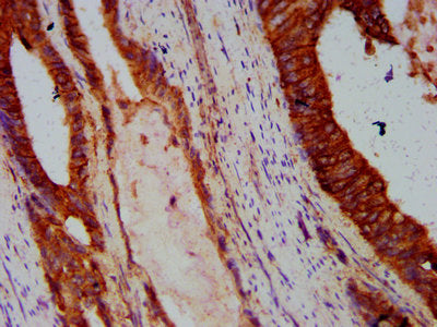 IHC image of CDH1 Antibody diluted at 1:300 and staining in paraffin-embedded human colon cancer performed on a Leica BondTM system. After dewaxing and hydration, antigen retrieval was mediated by high pressure in a citrate buffer (pH 6.0). Section was blocked with 10% normal goat serum 30min at RT. Then primary antibody (1% BSA) was incubated at 4°C overnight. The primary is detected by a biotinylated secondary antibody and visualized using an HRP conjugated SP system.Rabbit anti-Human CDH1 Polyclonal Antibody