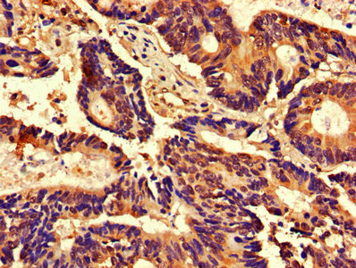 IHC image of CDK2 Antibody diluted at 1:800 and staining in paraffin-embedded human colon cancer performed on a Leica BondTM system. After dewaxing and hydration, antigen retrieval was mediated by high pressure in a citrate buffer (pH 6.0). Section was blocked with 10% normal goat serum 30min at RT. Then primary antibody (1% BSA) was incubated at 4°C overnight. The primary is detected by a biotinylated secondary antibody and visualized using an HRP conjugated SP system.Rabbit anti-Human CDK2 Polyclonal Antibody