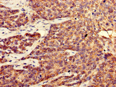Immunohistochemistry of paraffin-embedded human ovarian cancer using CDK5 Antibody at dilution of 1:100Rabbit anti-Human CDK5 Polyclonal Antibody