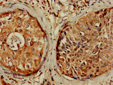 IHC image of CDKN1A Antibody diluted at 1:1200 and staining in paraffin-embedded human cervical cancer performed on a Leica BondTM system. After dewaxing and hydration, antigen retrieval was mediated by high pressure in a citrate buffer (pH 6.0). Section was blocked with 10% normal goat serum 30min at RT. Then primary antibody (1% BSA) was incubated at 4°C overnight. The primary is detected by a biotinylated secondary antibody and visualized using an HRP conjugated SP system.Rabbit anti-Human CDKN1A Polyclonal Antibody