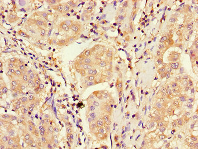 Immunohistochemistry of paraffin-embedded human liver cancer using CDKN2B Antibody at dilution of 1:100Rabbit anti-Human CDKN2B Polyclonal Antibody