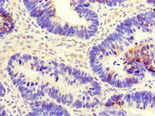 Immunohistochemistry of paraffin-embedded human ovarian cancer using the antibody at dilution of 1:100Rabbit anti-Human CEP290 Polyclonal Antibody