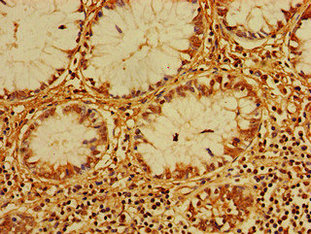 Immunohistochemistry of paraffin-embedded human colon cancer using CERK Antibody at dilution of 1:100
