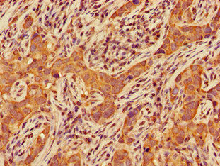 Immunohistochemistry of paraffin-embedded human pancreatic cancer using CERK Antibody at dilution of 1:100