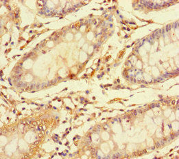 Immunohistochemistry of paraffin-embedded human colon cancer using CES3 Antibody at dilution of 1:100Rabbit anti-Human CES3 Polyclonal Antibody
