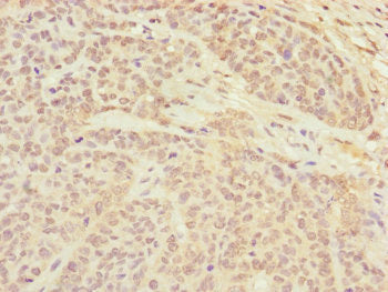 Immunohistochemistry of paraffin-embedded human ovarian cancer using CETN3 Antibody at dilution of 1:100Rabbit anti-Human CETN3 Polyclonal Antibody