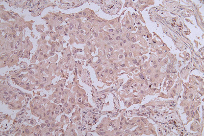 IHC image of CHAT Antibody diluted at 1:100 and staining in paraffin-embedded human endometrial cancer performed on a Leica BondTM system. After dewaxing and hydration, antigen retrieval was mediated by high pressure in a citrate buffer (pH 6.0). Section was blocked with 10% normal goat serum 30min at RT. Then primary antibody (1% BSA) was incubated at 4°C overnight. The primary is detected by a Goat anti-rabbit polymer IgG labeled by HRP and visualized using 0.05% DAB.Rabbit anti-Human CHAT Polyclonal Antibody