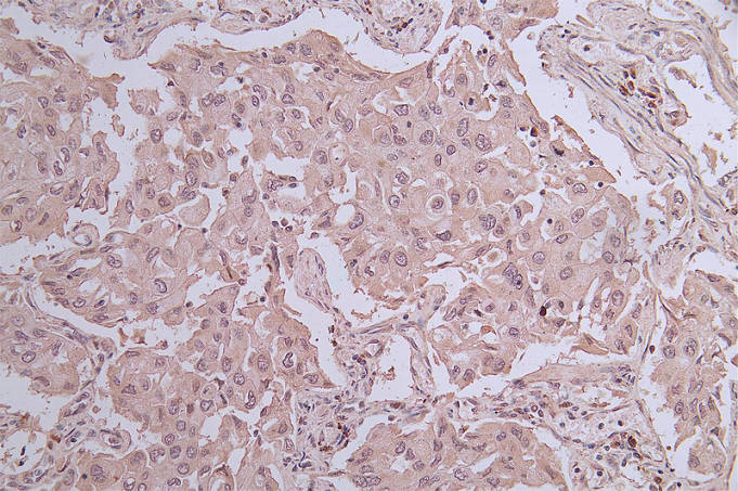 IHC image of CHAT Antibody diluted at 1:100 and staining in paraffin-embedded human endometrial cancer performed on a Leica BondTM system. After dewaxing and hydration, antigen retrieval was mediated by high pressure in a citrate buffer (pH 6.0). Section was blocked with 10% normal goat serum 30min at RT. Then primary antibody (1% BSA) was incubated at 4°C overnight. The primary is detected by a Goat anti-rabbit polymer IgG labeled by HRP and visualized using 0.05% DAB.Rabbit anti-Human CHAT Polyclonal Antibody