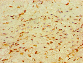 Immunohistochemistry of paraffin-embedded human breast cancer using the antibody at dilution of 1:100Rabbit anti-Human CHD1 Polyclonal Antibody