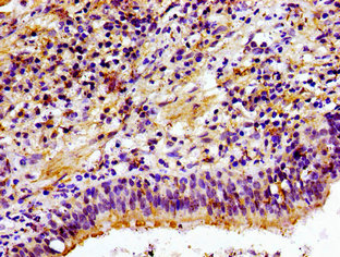 Immunohistochemistry of paraffin-embedded human lung cancer using CHKA Antibody at dilution of 1:100Rabbit anti-Human CHKA Polyclonal Antibody