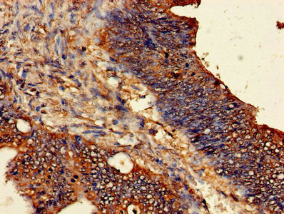 Immunohistochemistry of paraffin-embedded human colon cancer using ODC1 Antibody at dilution of 1:100Rabbit anti-Human ODC1 Polyclonal Antibody