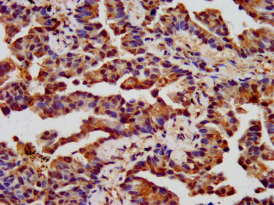 IHC image of CHRNB3 Antibody diluted at 1:400 and staining in paraffin-embedded human lung cancer performed on a Leica BondTM system. After dewaxing and hydration, antigen retrieval was mediated by high pressure in a citrate buffer (pH 6.0). Section was blocked with 10% normal goat serum 30min at RT. Then primary antibody (1% BSA) was incubated at 4°C overnight. The primary is detected by a biotinylated secondary antibody and visualized using an HRP conjugated SP system.Rabbit anti-Human CHRNB3 Polyclonal Antibody