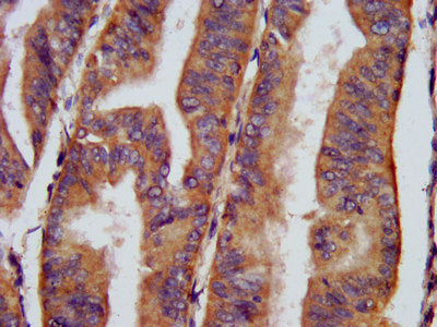 IHC image of CHRNB3 Antibody diluted at 1:400 and staining in paraffin-embedded human endometrial cancer performed on a Leica BondTM system. After dewaxing and hydration, antigen retrieval was mediated by high pressure in a citrate buffer (pH 6.0). Section was blocked with 10% normal goat serum 30min at RT. Then primary antibody (1% BSA) was incubated at 4°C overnight. The primary is detected by a biotinylated secondary antibody and visualized using an HRP conjugated SP system.Rabbit anti-Human CHRNB3 Polyclonal Antibody