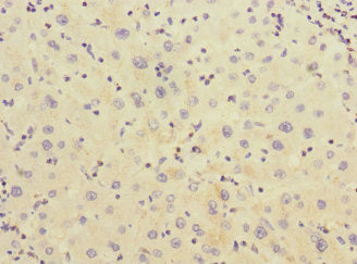 Immunohistochemistry of paraffin-embedded human liver cancer using CHRNE Antibody at dilution of 1:100Rabbit anti-Human CHRNE Polyclonal Antibody