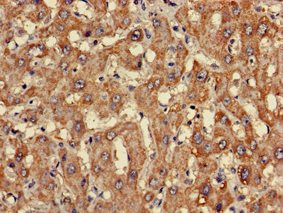 Immunohistochemistry of paraffin-embedded human liver cancer using the antibody at dilution of 1:100Rabbit anti-Human CLASP2 Polyclonal Antibody