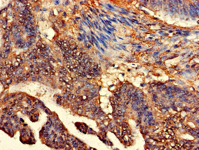 Immunohistochemistry of paraffin-embedded human colon cancer using CLASP2 Antibody at dilution of 1:100Rabbit anti-Human CLASP2 Polyclonal Antibody