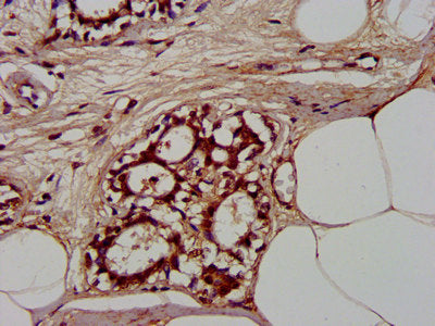 IHC image of CLCNKB Antibody diluted at 1:300 and staining in paraffin-embedded human breast cancer performed on a Leica BondTM system. After dewaxing and hydration, antigen retrieval was mediated by high pressure in a citrate buffer (pH 6.0). Section was blocked with 10% normal goat serum 30min at RT. Then primary antibody (1% BSA) was incubated at 4°C overnight. The primary is detected by a biotinylated secondary antibody and visualized using an HRP conjugated SP system.Rabbit anti-Human CLCNKB Polyclonal Antibody