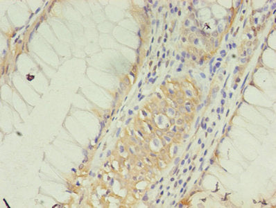 Immunohistochemistry of paraffin-embedded human colon cancer using the antibody at dilution of 1:100Rabbit anti-Human CLDN15 Polyclonal Antibody