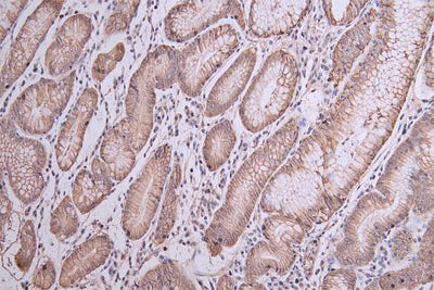 IHC image of CLDN18 Antibody diluted at 1:50 and staining in paraffin-embedded human gastric cancer  tissue performed on a Leica BondTM system. After dewaxing and hydration, antigen retrieval was mediated by high pressure in a citrate buffer (pH 6.0). Section was blocked with 10% normal goat serum 30min at RT. Then primary antibody (1% BSA) was incubated at 4°C overnight. The primary is detected by a Goat anti-rabbit polymer IgG labeled by HRP and visualized using 0.05% DAB.Rabbit anti-Human CLDN18 Polyclonal Antibody
