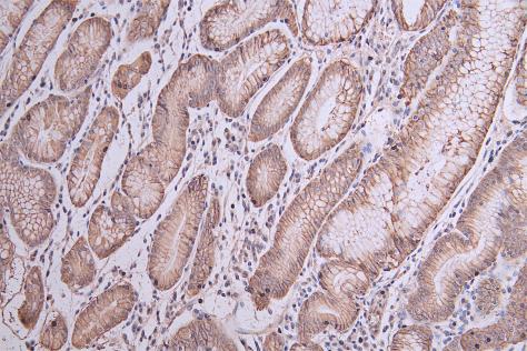 IHC image of CLDN18 Antibody diluted at 1:50 and staining in paraffin-embedded human gastric cancer  tissue performed on a Leica BondTM system. After dewaxing and hydration, antigen retrieval was mediated by high pressure in a citrate buffer (pH 6.0). Section was blocked with 10% normal goat serum 30min at RT. Then primary antibody (1% BSA) was incubated at 4°C overnight. The primary is detected by a Goat anti-rabbit polymer IgG labeled by HRP and visualized using 0.05% DAB.Rabbit anti-Human CLDN18 Polyclonal Antibody