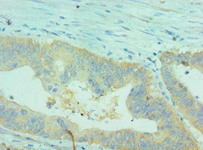 Immunohistochemistry of paraffin-embedded human colon cancer using CLDN2 Antibody at dilution of 1:100Rabbit anti-Human CLDN2 Polyclonal Antibody
