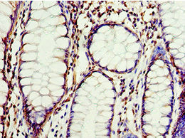 Immunohistochemistry of paraffin-embedded human colon cancer using the antibody at dilution of 1:100Rabbit anti-Human CLDN8 Polyclonal Antibody