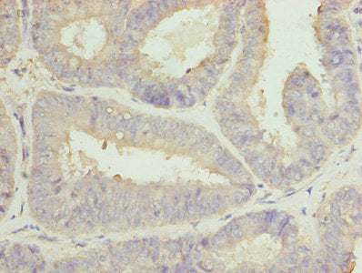 Immunohistochemistry of paraffin-embedded human endometrial cancer using CLGN Antibody at dilution of 1:100Rabbit anti-Human CLGN Polyclonal Antibody