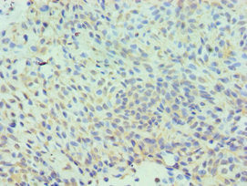 Immunohistochemistry of paraffin-embedded human breast cancer using CLIC1 Antibody at dilution of 1:100Rabbit anti-Human CLIC1 Polyclonal Antibody