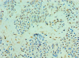 Immunohistochemistry of paraffin-embedded human breast cancer using CLIC4 Antibody at dilution of 1:100Rabbit anti-Human CLIC4 Polyclonal Antibody