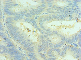 Immunohistochemistry of paraffin-embedded human colon cancer using CLIC4 Antibody at dilution of 1:100Rabbit anti-Human CLIC4 Polyclonal Antibody