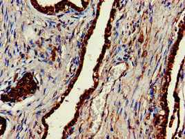 Immunohistochemistry of paraffin-embedded human prostate cancer using the antibody at dilution of 1:100Rabbit anti-Human CLINT1 Polyclonal Antibody