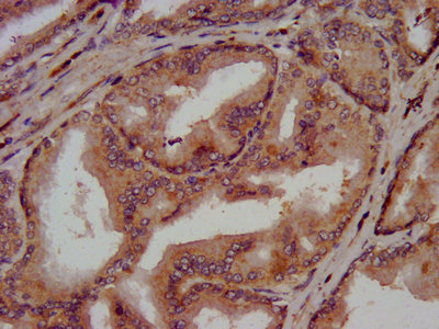 IHC image of the antibody diluted at 1:300 and staining in paraffin-embedded human prostate tissue performed on a Leica BondTM system. After dewaxing and hydration, antigen retrieval was mediated by high pressure in a citrate buffer (pH 6.0). Section was blocked with 10% normal goat serum 30min at RT. Then primary antibody (1% BSA) was incubated at 4°C overnight. The primary is detected by a biotinylated secondary antibody and visualized using an HRP conjugated SP system.Rabbit anti-Human CLN5 Polyclonal Antibody