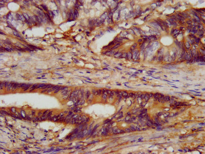 IHC image of CLN5 Antibody diluted at 1:300 and staining in paraffin-embedded human colon cancer performed on a Leica BondTM system. After dewaxing and hydration, antigen retrieval was mediated by high pressure in a citrate buffer (pH 6.0). Section was blocked with 10% normal goat serum 30min at RT. Then primary antibody (1% BSA) was incubated at 4°C overnight. The primary is detected by a biotinylated secondary antibody and visualized using an HRP conjugated SP system.Rabbit anti-Human CLN5 Polyclonal Antibody