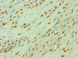 Immunohistochemistry of paraffin-embedded human breast cancer using CLOCK Antibody at dilution of 1:100Rabbit anti-Human CLOCK Polyclonal Antibody
