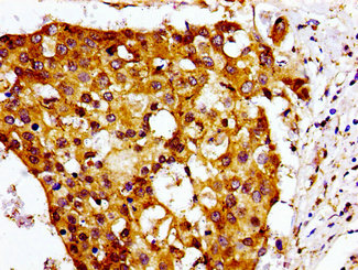 Immunohistochemistry of paraffin-embedded human breast cancer using CMKLR1 Antibody at dilution of 1:100Rabbit anti-Human CMKLR1 Polyclonal Antibody