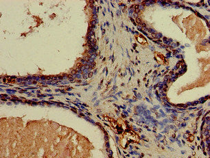 Immunohistochemistry of paraffin-embedded human prostate cancer using the antibody at dilution of 1:100Rabbit anti-Human CNN3 Polyclonal Antibody
