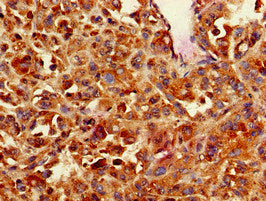 Immunohistochemistry of paraffin-embedded human melanoma using CNN3 Antibody at dilution of 1:100Rabbit anti-Human CNN3 Polyclonal Antibody