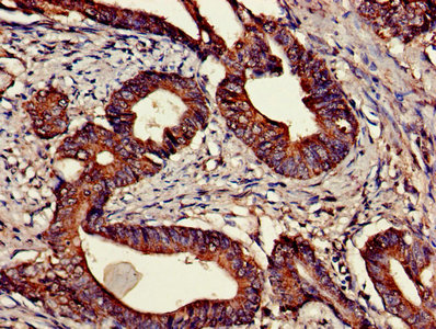 Immunohistochemistry of paraffin-embedded human colon cancer using CNTFR Antibody at dilution of 1:100Rabbit anti-Human CNTFR Polyclonal Antibody
