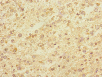 Immunohistochemistry of paraffin-embedded human glioma using CNTNAP1 Antibody at dilution of 1:100Rabbit anti-Human CNTNAP1 Polyclonal Antibody