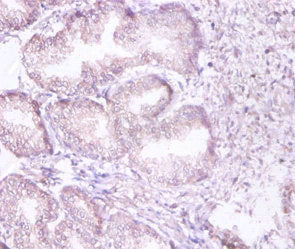 Immunohistochemistry of paraffin-embedded human prostate tissue using the antibody at dilution of 1:100Rabbit anti-Human PSMD11 Polyclonal Antibody