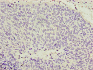 Immunohistochemistry of paraffin-embedded human cervical cancer using COPZ1 Antibody at dilution of 1:100Rabbit anti-Human COPZ1 Polyclonal Antibody