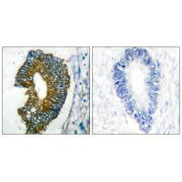 Immunohistochemical analysis of paraffin-embedded human lung carcinoma tissue using Keratin 18 antibody.