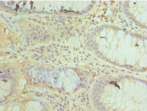 Immunohistochemistry of paraffin-embedded human colon cancer using COX4I1 Antibody at dilution of 1:100Rabbit anti-Human COX4I1 Polyclonal Antibody