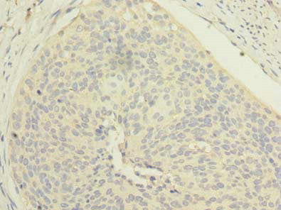 Immunohistochemistry of paraffin-embedded human cervical cancer using EMC8 Antibody at dilution of 1:100Rabbit anti-Human EMC8 Polyclonal Antibody