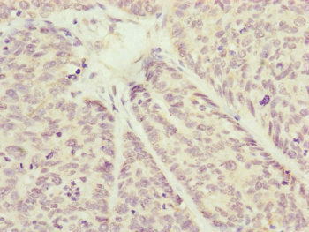 Immunohistochemistry of paraffin-embedded human ovarian cancer using COX7A2L Antibody at dilution of 1:100Rabbit anti-Human COX7A2L Polyclonal Antibody