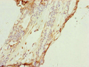 Immunohistochemistry of paraffin-embedded human breast cancer using COX7A2L Antibody at dilution of 1:100Rabbit anti-Human COX7A2L Polyclonal Antibody