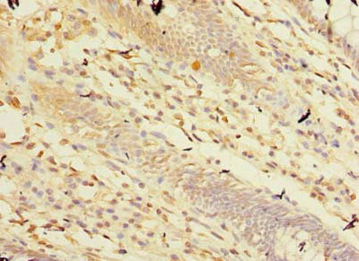 Immunohistochemistry of paraffin-embedded human colon cancer using CPA2 Antibody at dilution of 1:100Rabbit anti-Human CPA2 Polyclonal Antibody