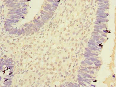 Immunohistochemistry of paraffin-embedded human ovarian cancer using CPA2 Antibody at dilution of 1:100Rabbit anti-Human CPA2 Polyclonal Antibody